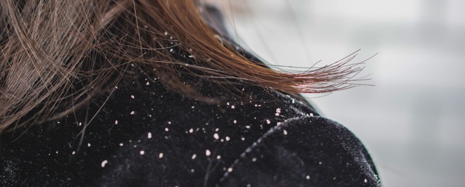 Saçta Kepek Oluşumu Nasıl Geçer?