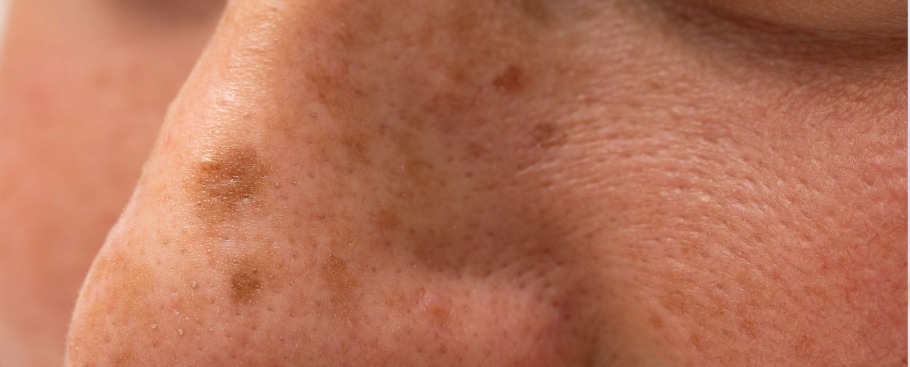 Cilt Lekeleri İçin Ne Yapabiliriz?