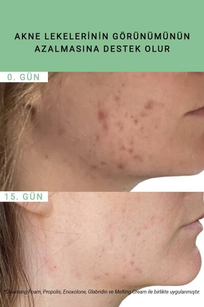 Etat Pur Pure Active Propolis Siyah Nokta Görünümüne Karşı Saf Konsantre Bakım 15 ml - 10