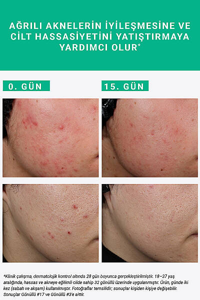 Etat Pur Pure Active Süksinik Asit %2 Hassas Ciltler için Akne ve Leke Karşıtı Konsantre Bakım Serumu 15 ml - 3